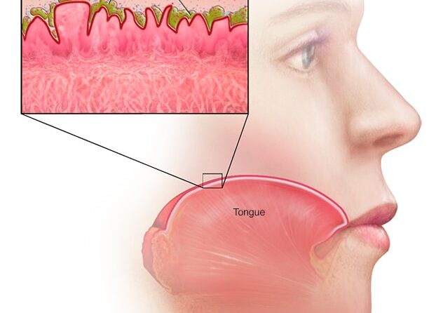 Halitoza: Cauze, Simptome și Opțiuni de Tratament pentru Respirația Urât Mirositoare