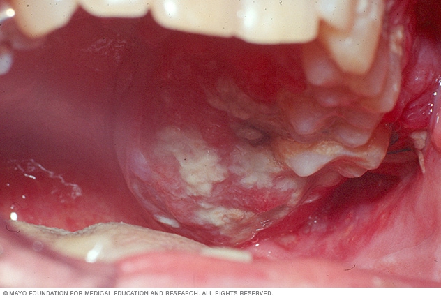 Cancerul bucal (oral).  Ce este, care sunt simptomele si CUM se trateaza